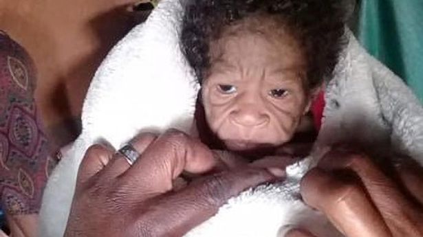 Baby alleged to have had progeria passes away