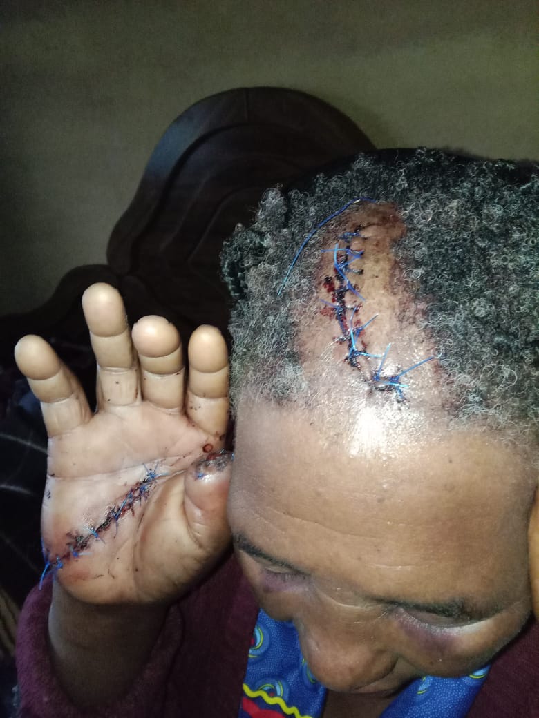 Mbambangwe woman survives brutal bush-knife attack by relative accusing her of witchcraft